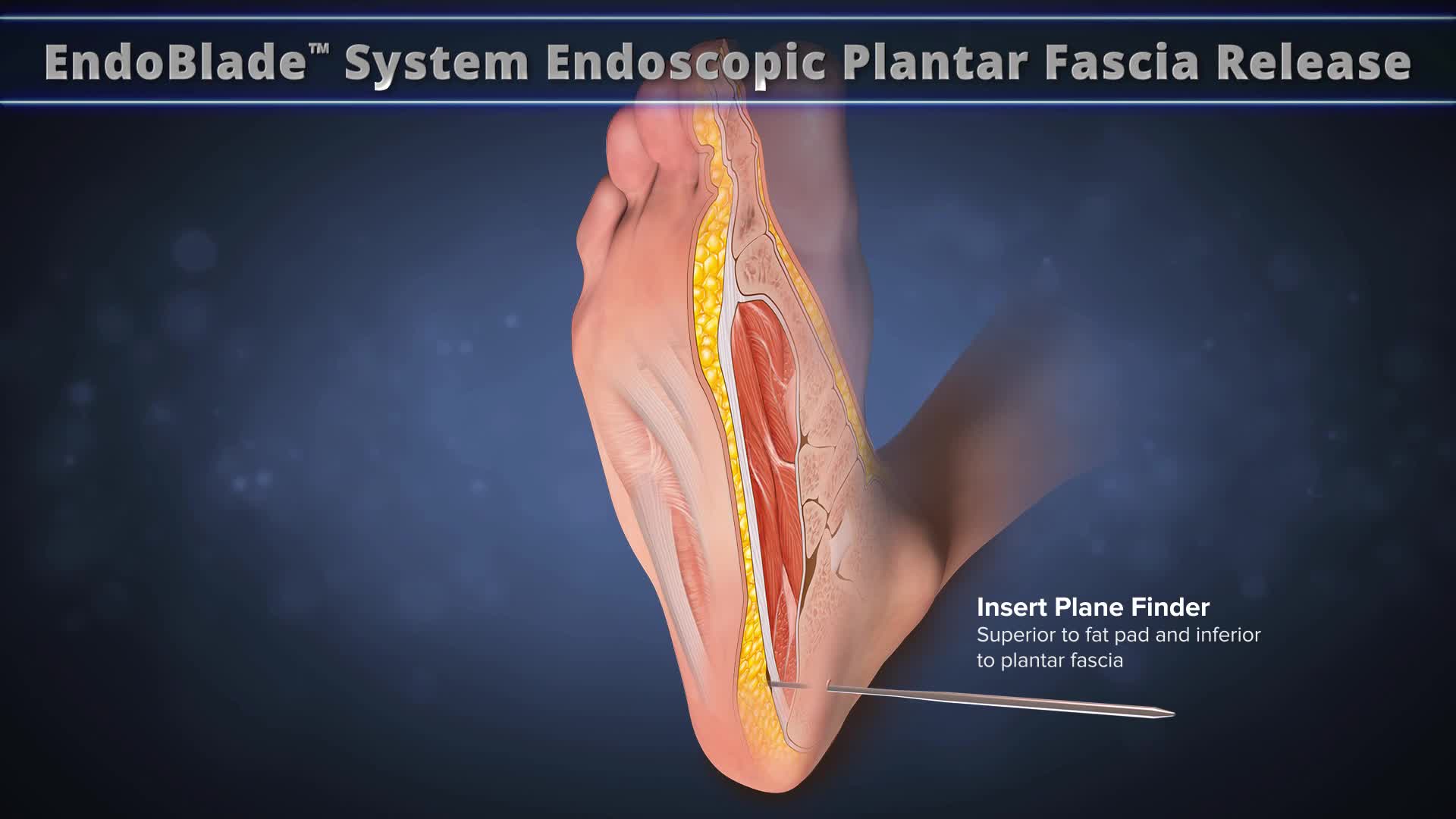 arthrex-endoblade-system-endoscopic-plantar-fascia-release