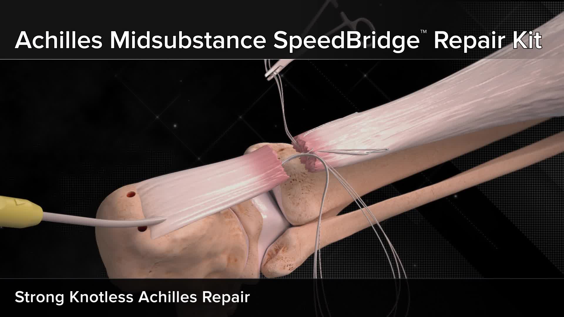 Arthrex - Achilles Midsubstance SpeedBridge™ Repair Kit