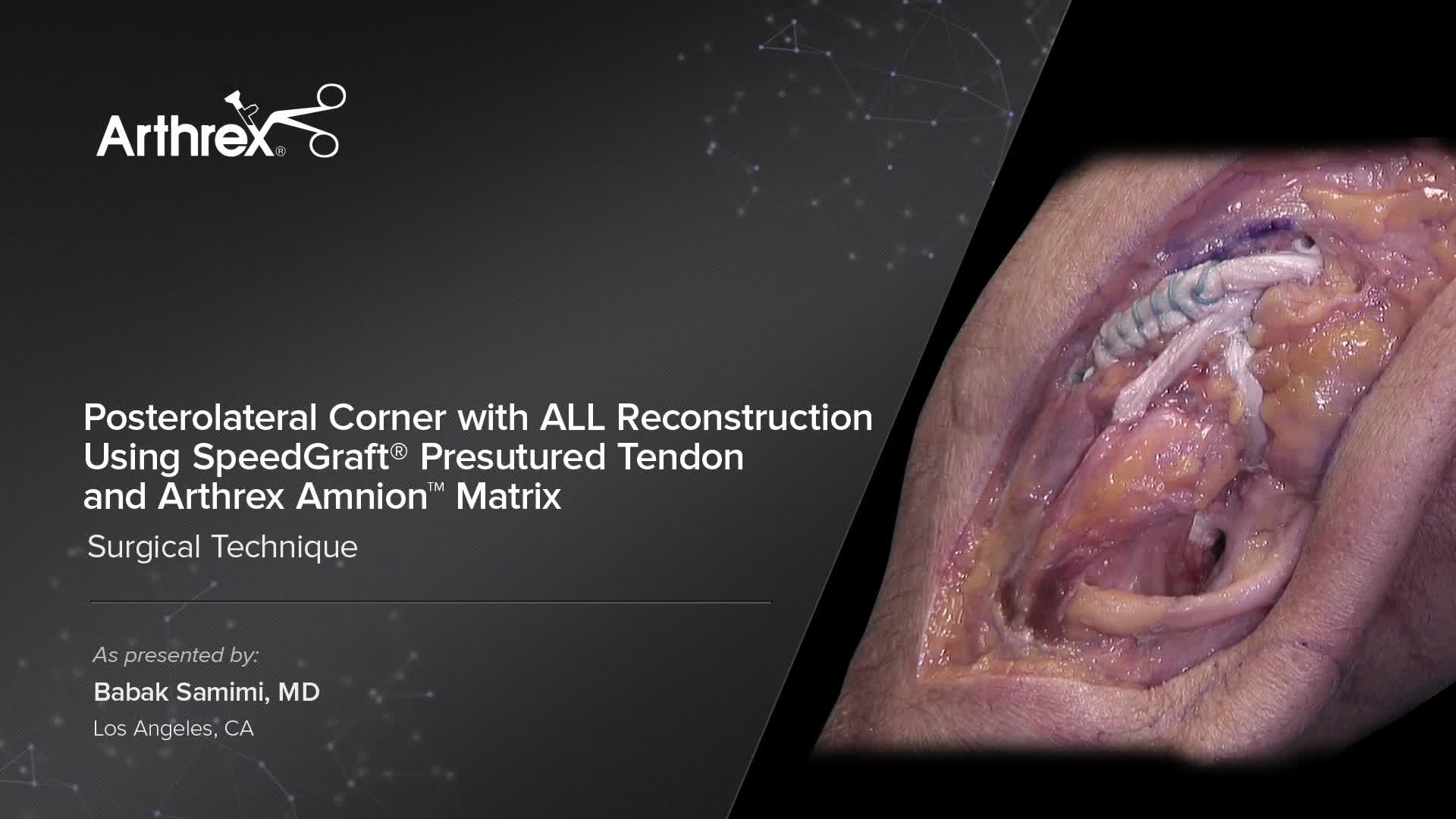 Arthrex Posterolateral Corner with ALL Reconstruction Using