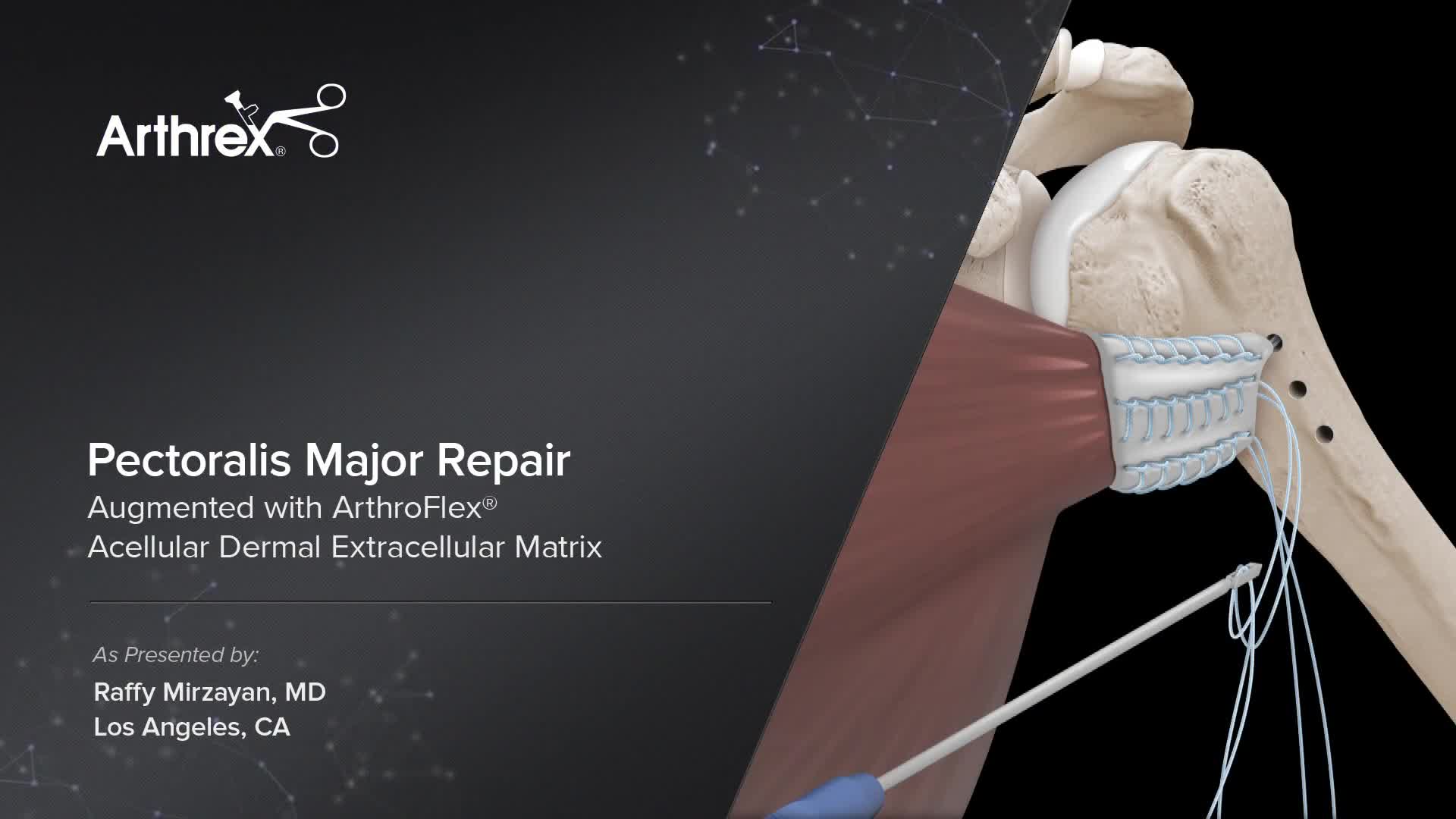 Arthrex Pectoralis Major Repair Augmented With Arthroflex® Acellular Dermal Extracellular Matrix