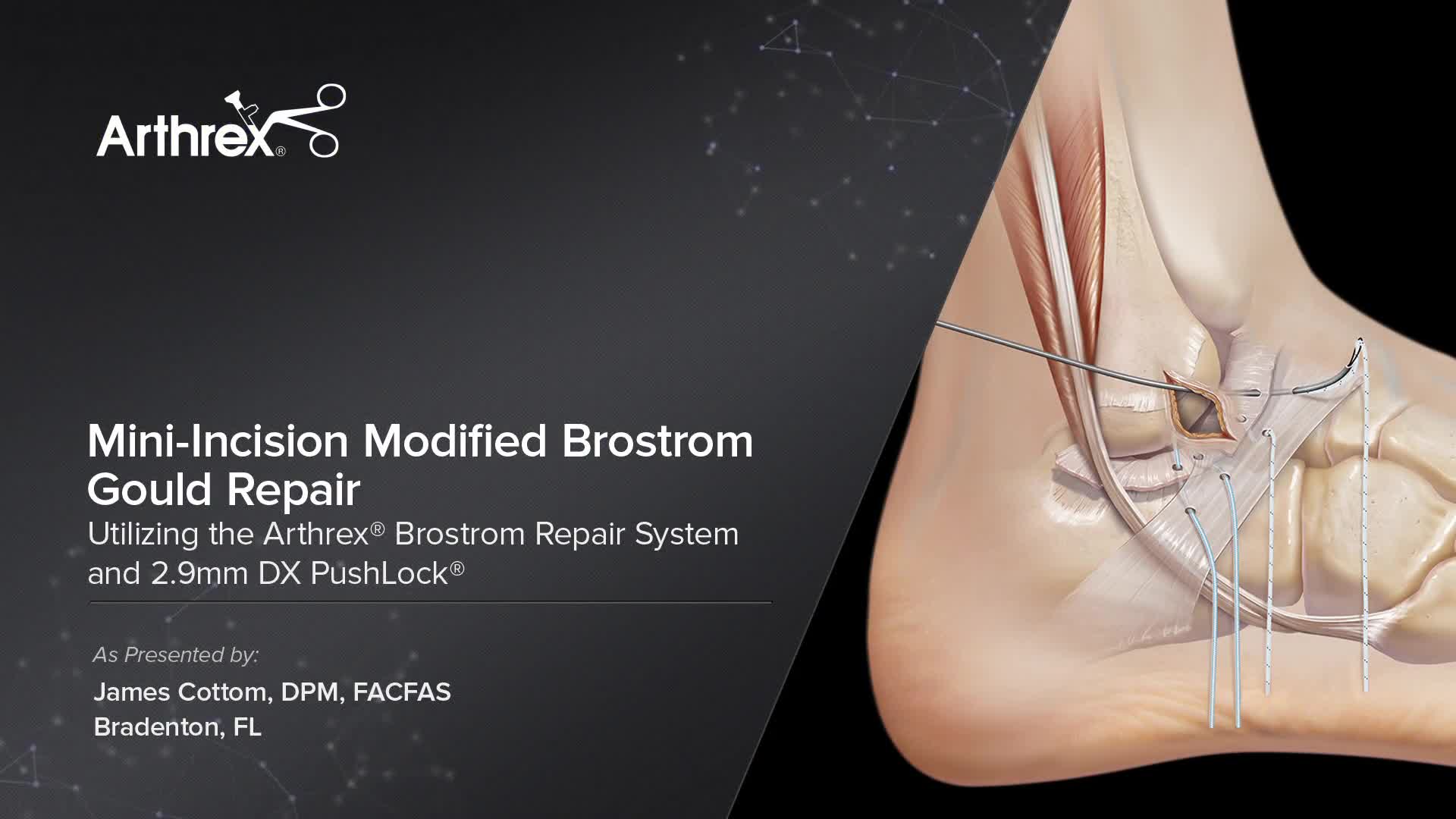 Arthrex Mini Incision Modified Brostrom Gould Repair Utilizing The arthrex-mini-incision-modified-brostrom-gould-repair-utilizing-the