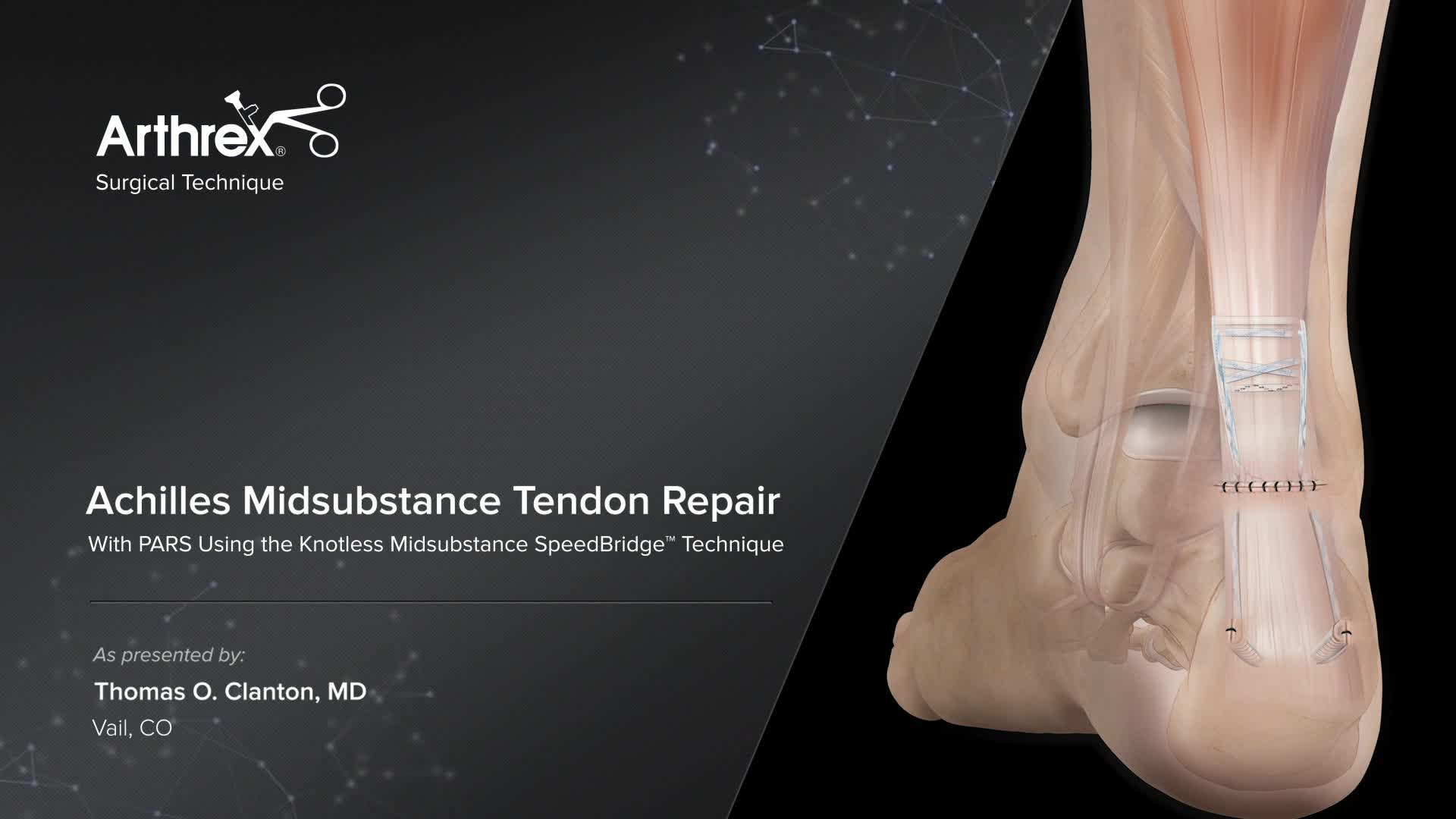 Arthrex - Achilles Midsubstance Tendon Repair With PARS Using the 