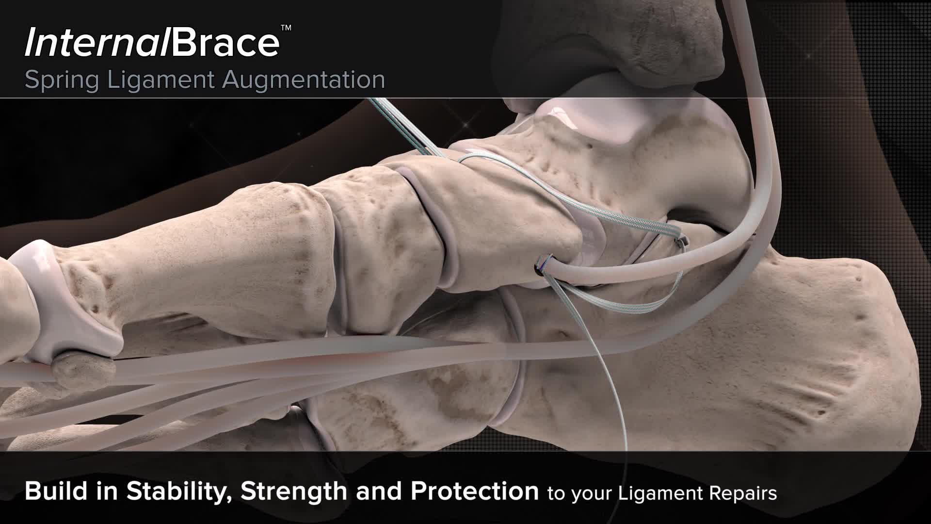 Arthrex InternalBrace™ Spring Ligament Augmentation
