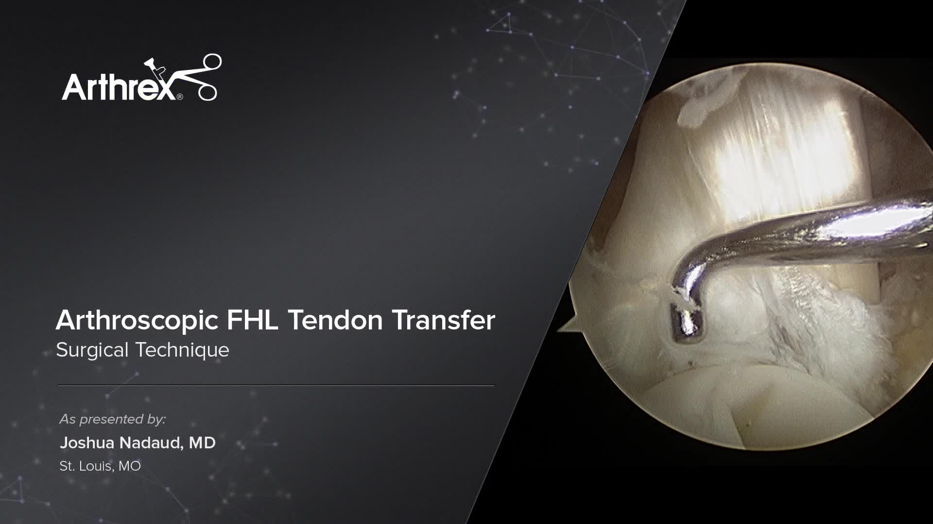 Arthrex - Arthroscopic FHL Tendon Transfer