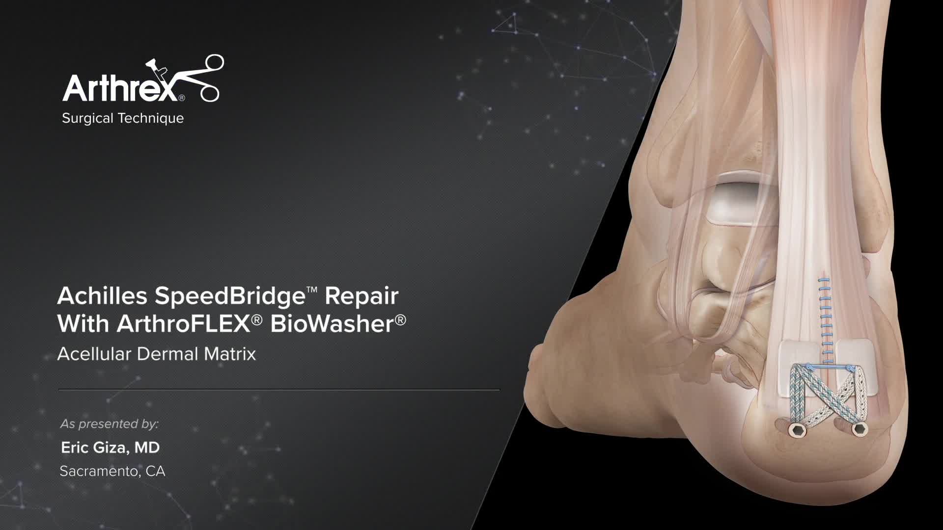 Arthrex - Achilles SpeedBridge™ Repair With ArthroFLEX® BioWasher®