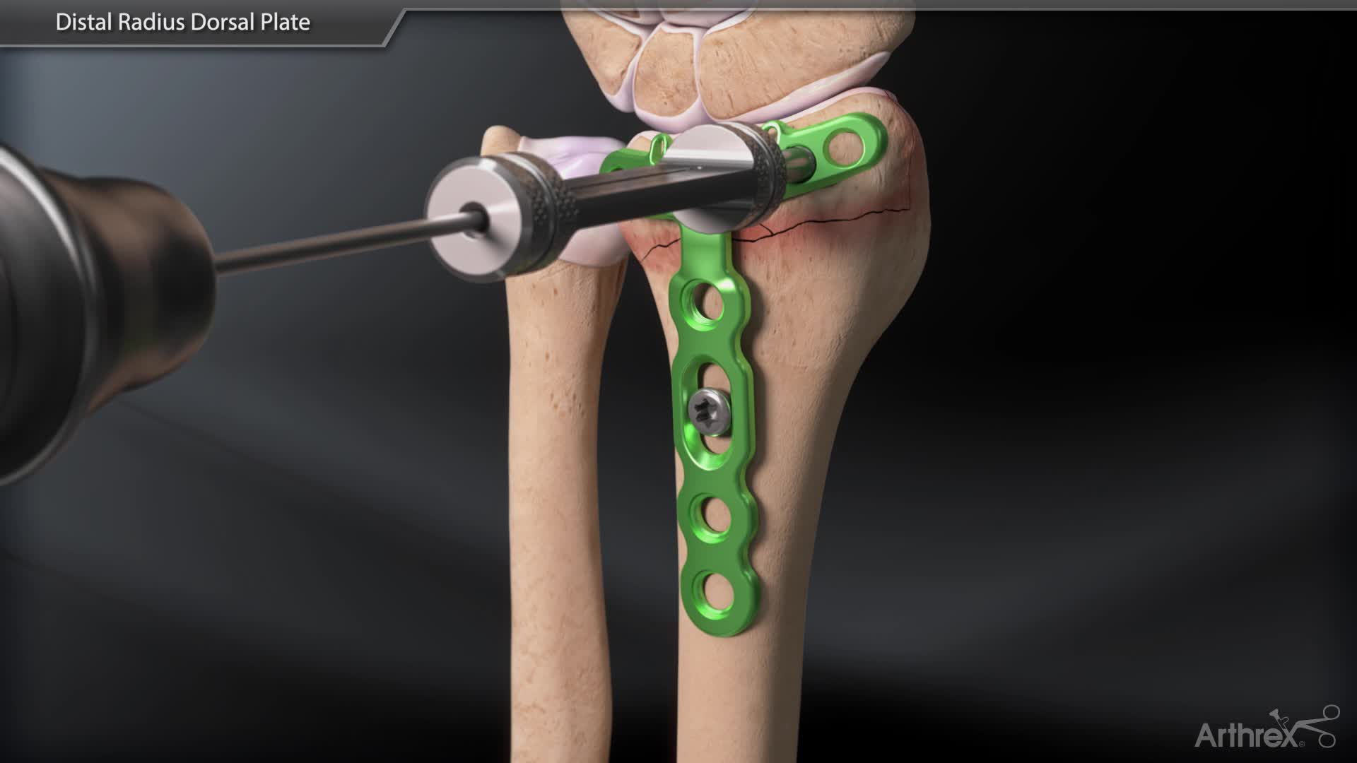 Arthrex - Distal Radius Dorsal Plate