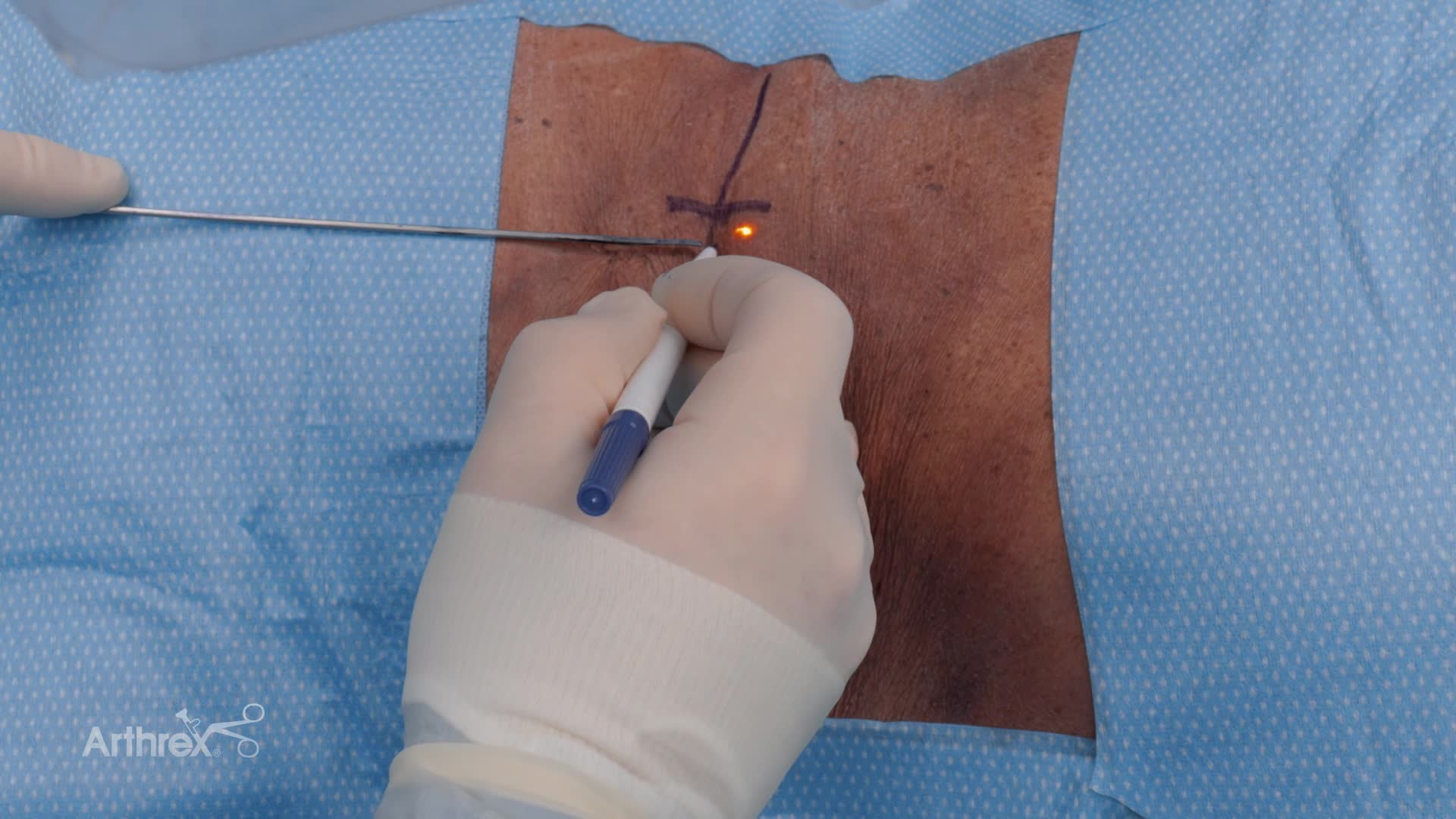 Arthrex Endoscopic Approach to Transforaminal Discectomy