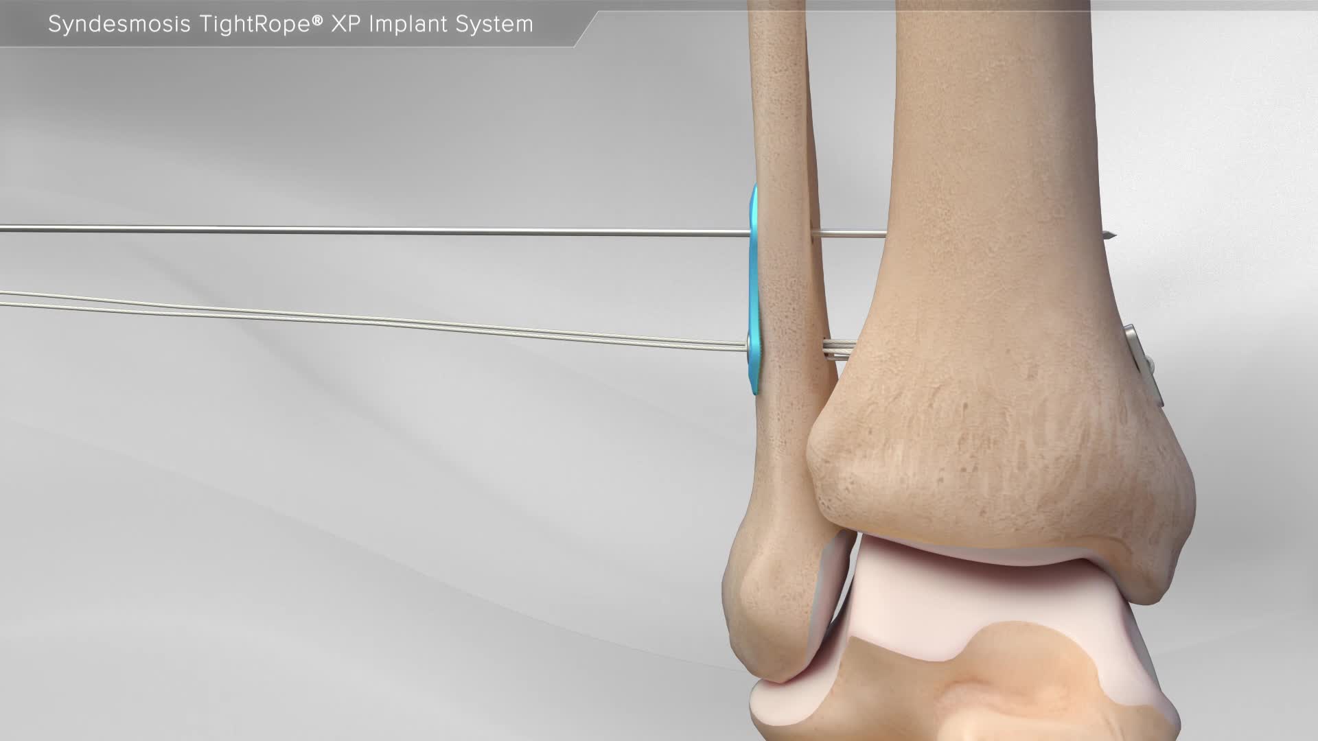 Arthrex - Syndesmosis TightRope® XP Implant System