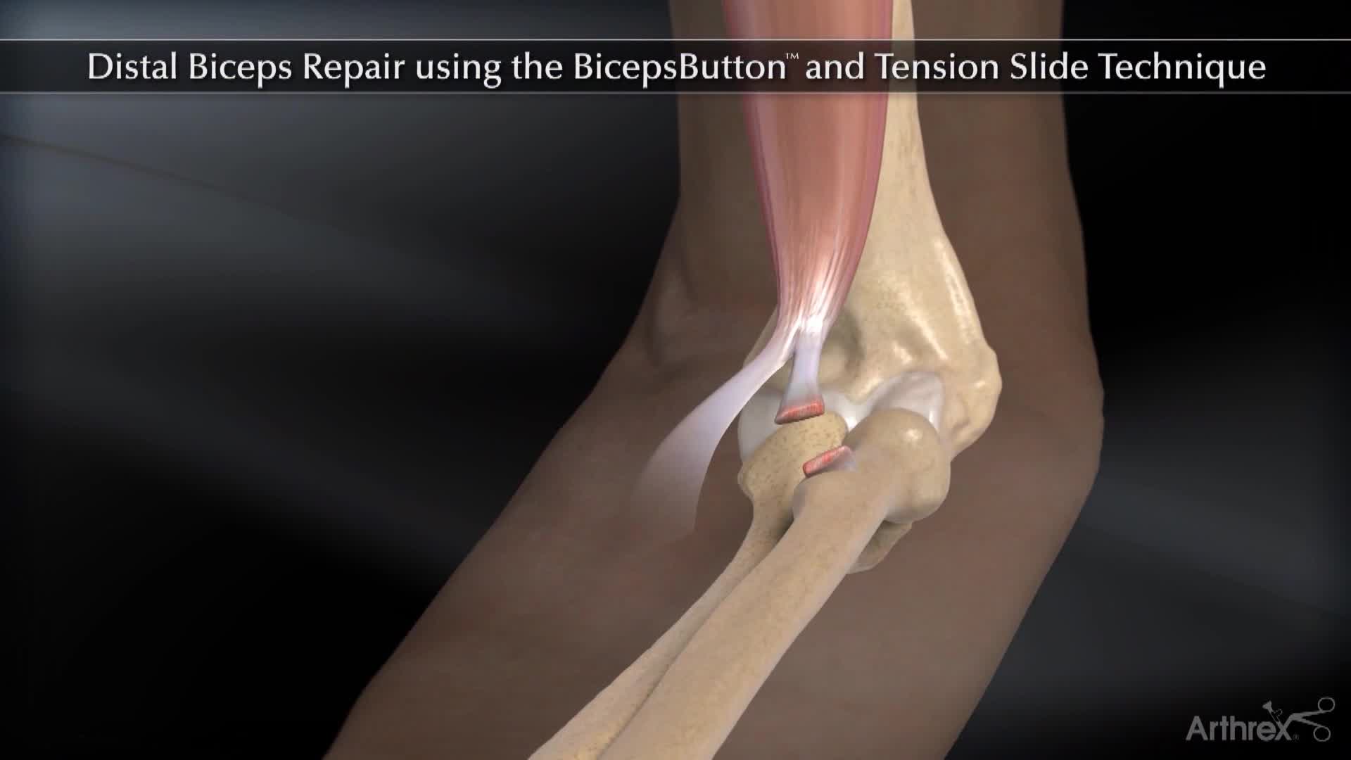 Arthrex Distal BicepsButton™ Tension Slide Technique