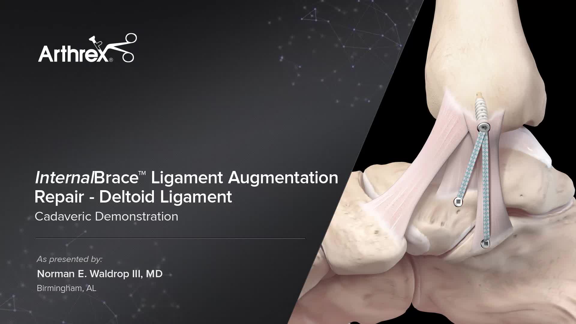 Arthrex InternalBrace™ Ligament Augmentation Repair—Deltoid Ligament