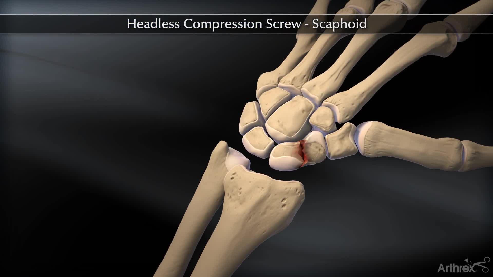 Arthrex - Headless Compression Screw – Scaphoid