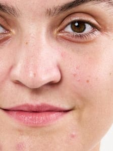Peau impure et sujette à l'acné