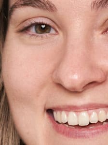 Pores dilatés