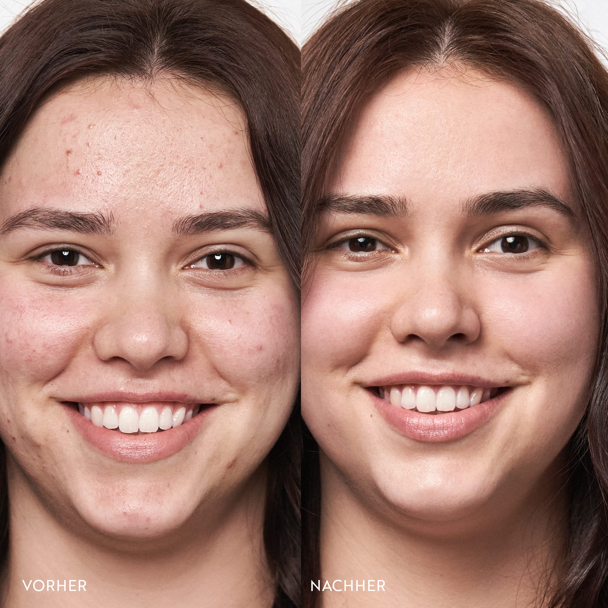 Frau mit verfeinerten Poren nach Anwendung der Clear Skin Linie von M.Asam