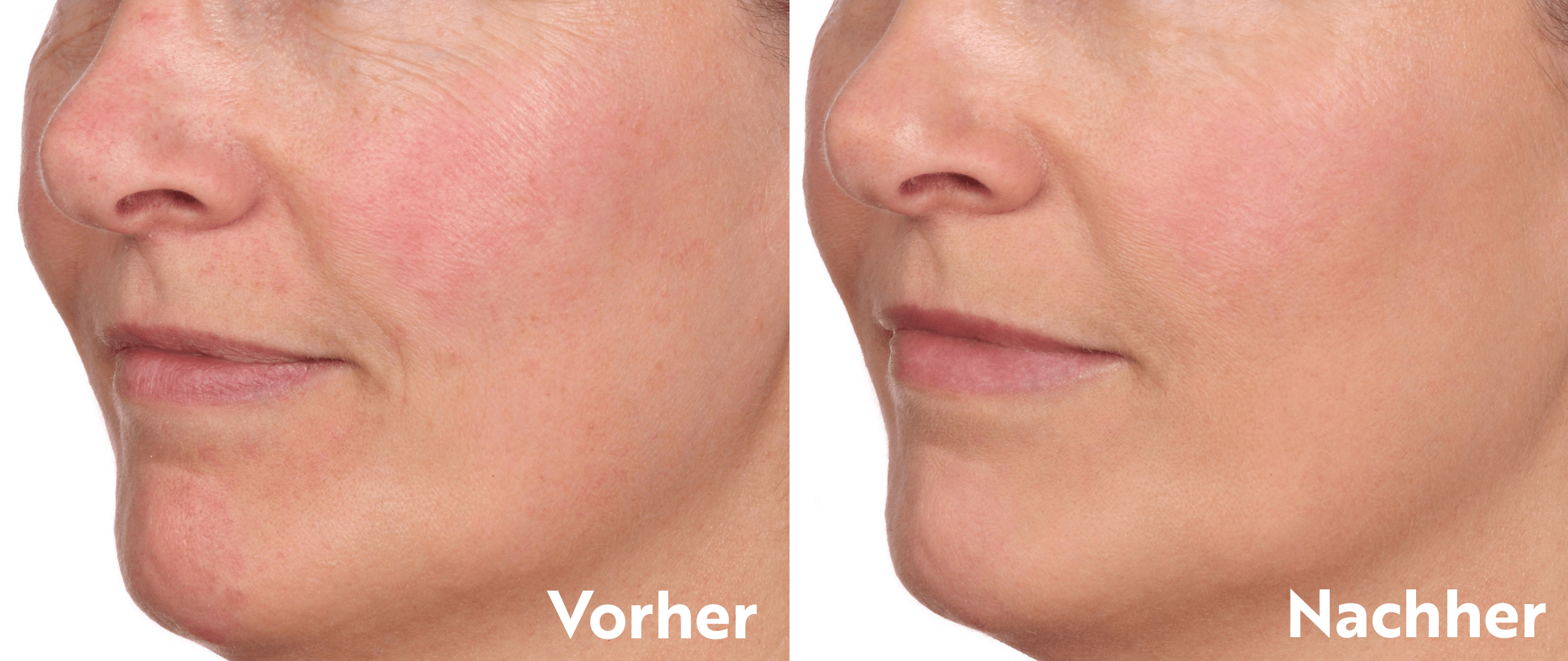 Vorher-Nachher-Foto einer Frau nach Anwendung des Aqua Intense Mimic Booster Serum von M.Asam