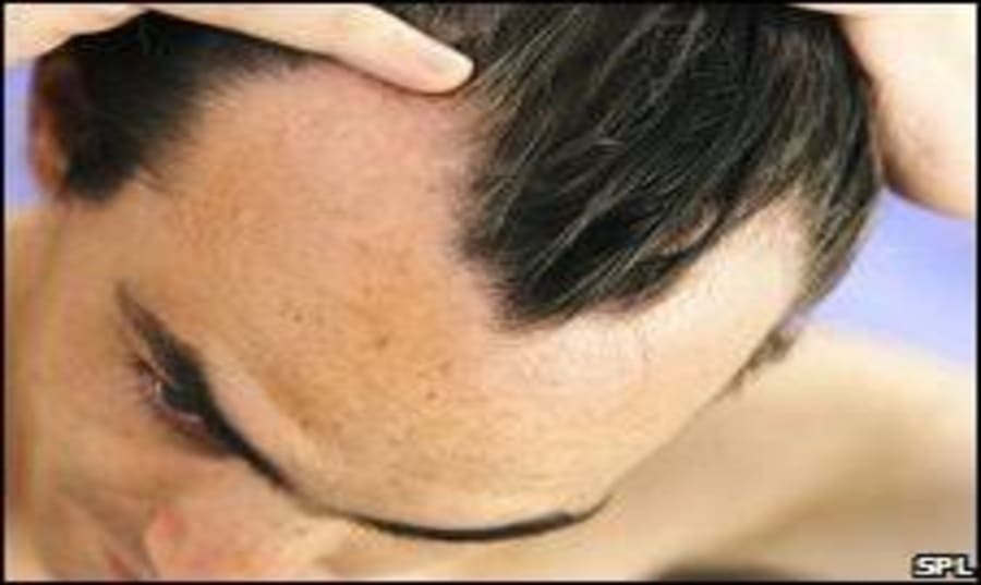 best-genetic-treatment-for-hair-loss Image