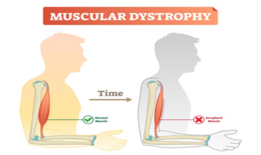 what-are-muscular-dystrophies Image