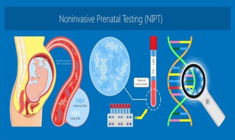 trisomy 21