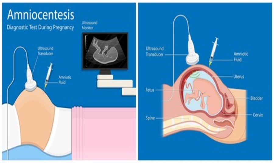 amniocentesis-test-cost Image