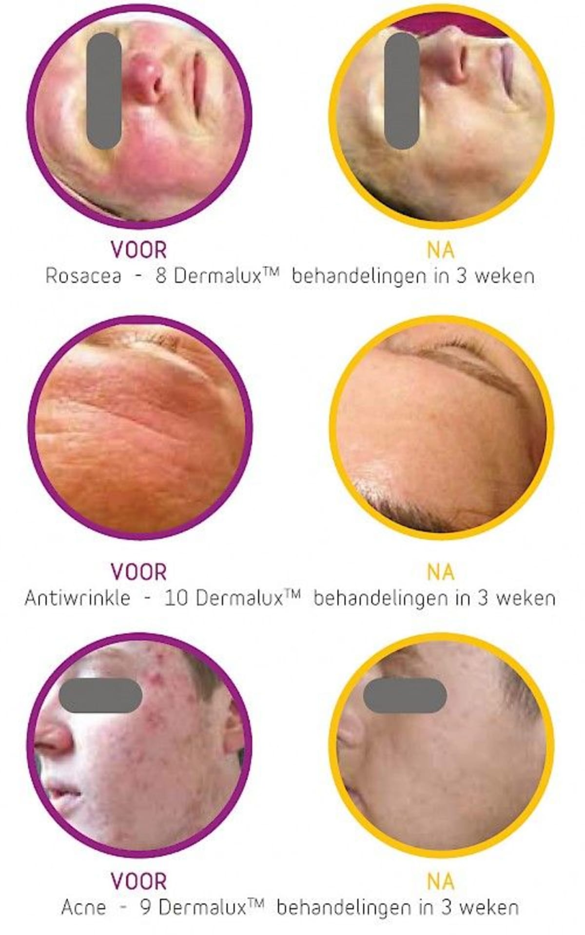 LED Fototherapie voor/na