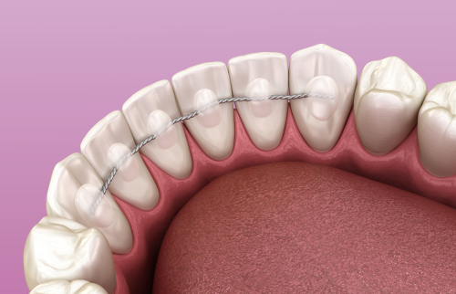 Ilustrație aparat dentar de contenție