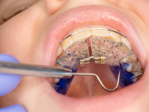 Ilustrație aparat dentar mobil