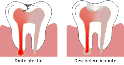 Ilustratie Tratament Endodontic - Carie si Deschidere Dinte.