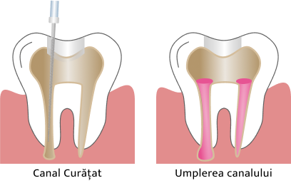 Ilustratie Tratament Endodontic - Carie si Deschidere Dinte.