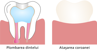 Ilustratie Tratament Endodontic - Carie si Deschidere Dinte.