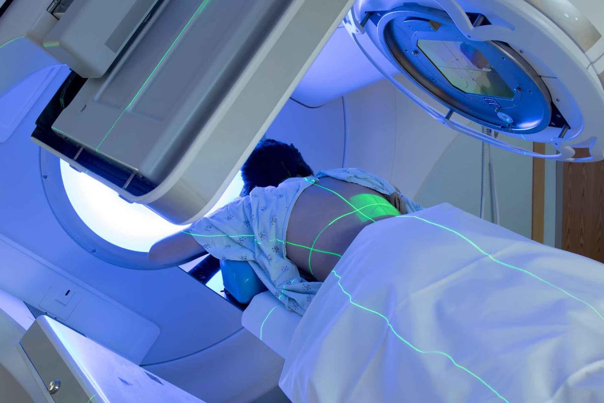 Proton Therapy for Throat Cancer Linked to Higher Risk of Severe Dry Mouth, Study Finds