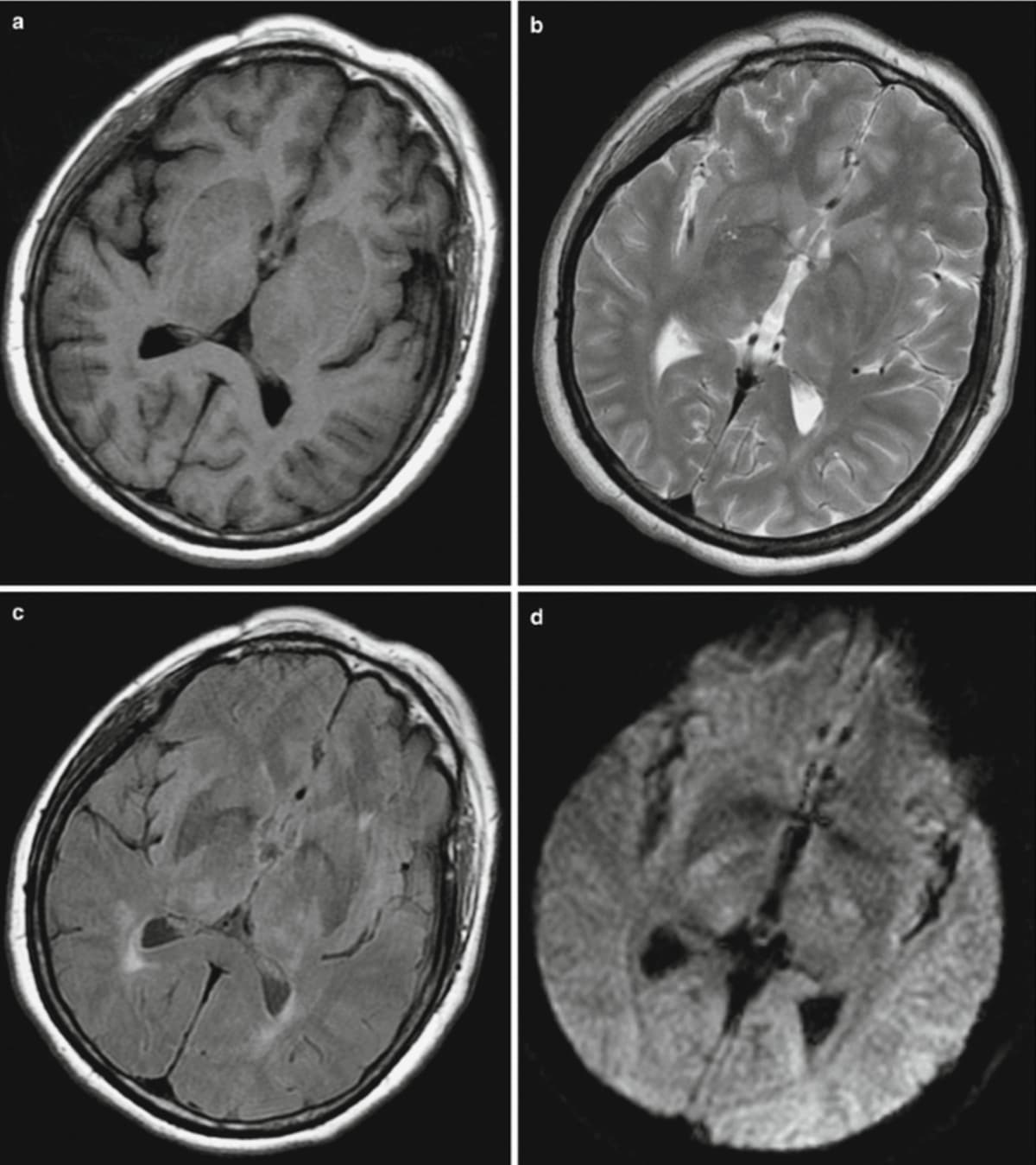 Encephalitis Rising: Silent Brain Inflammation Demands Urgent Action, Experts Warn