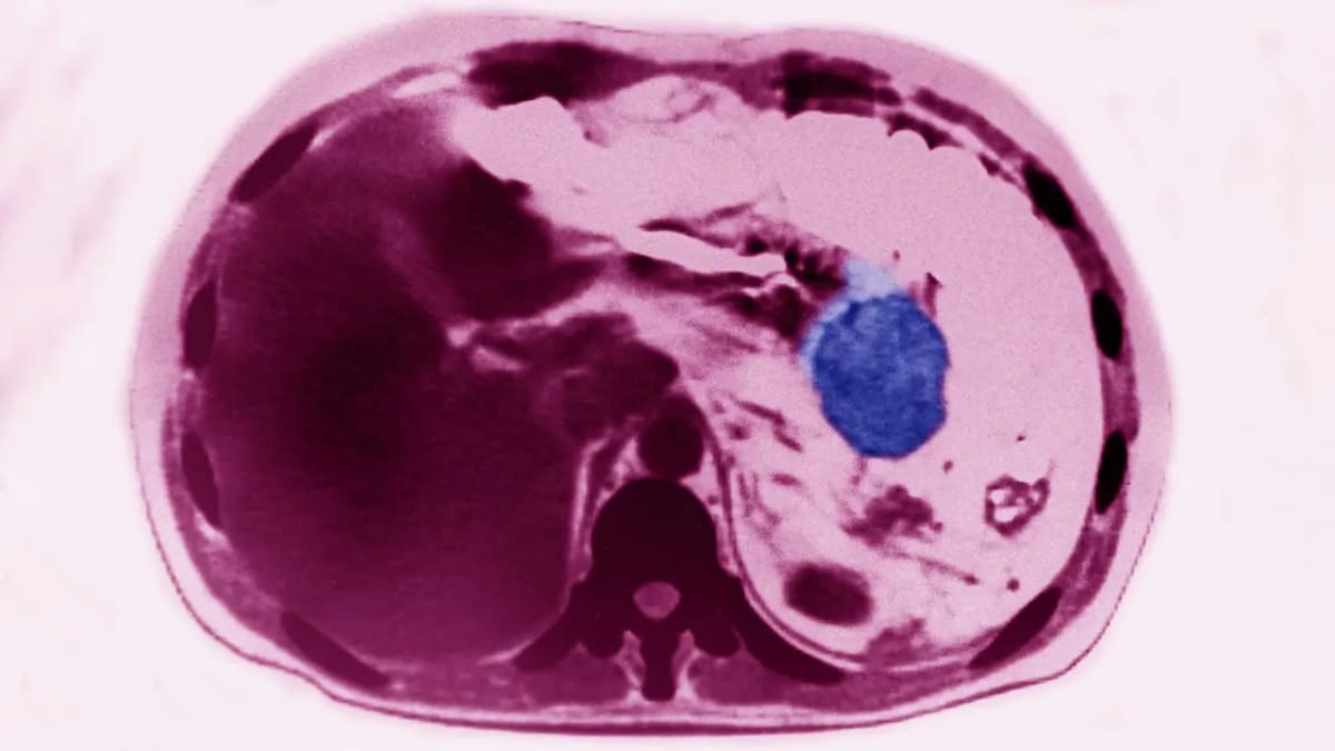 Low risk pancreatic cysts linked to sharply higher cancer risk, study finds