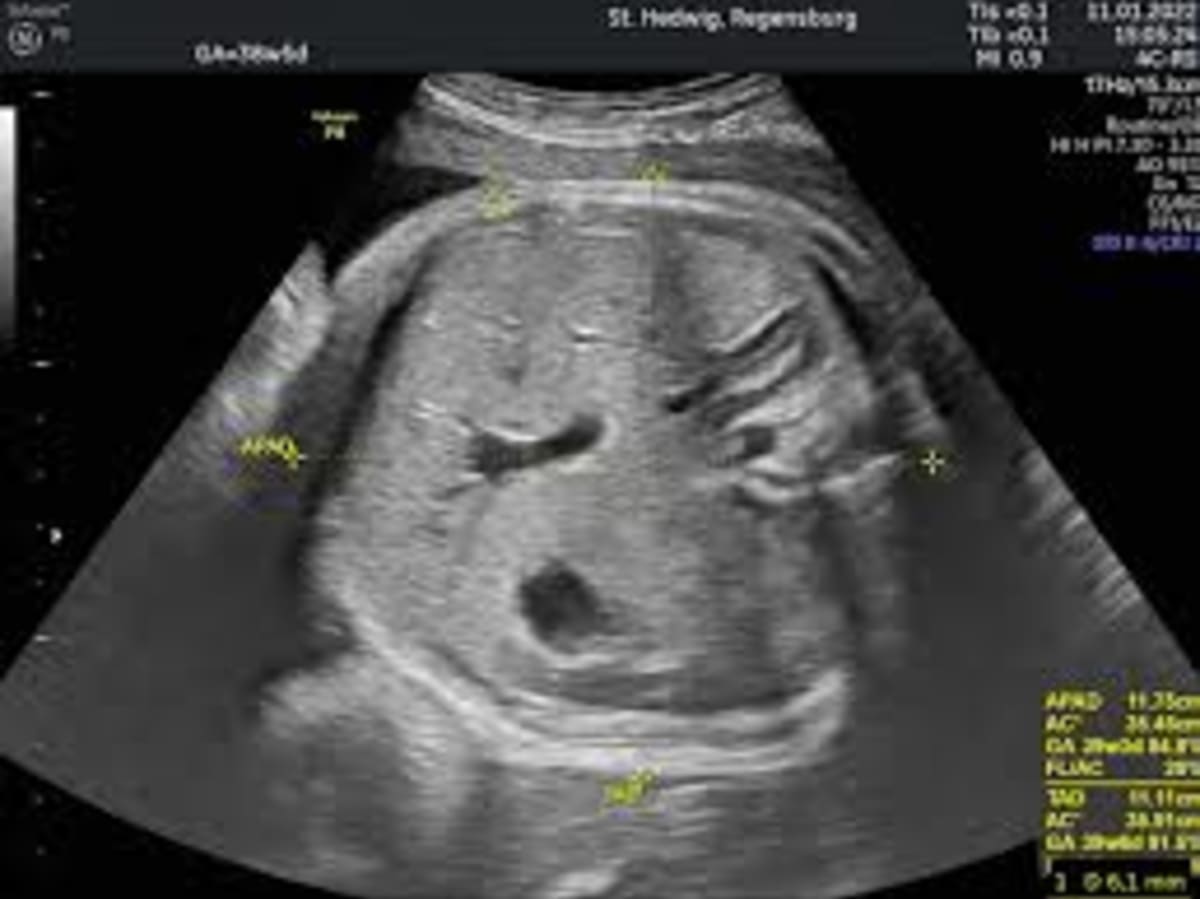 Ultrasound Measurement of Fetal Abdominal Fat May Improve Birth Weight Prediction in Diabetic Pregnancies