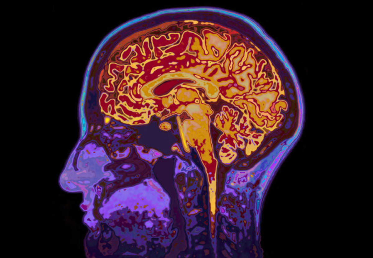Diabetes and Dementia: The Hidden Links Reshaping Brain Health