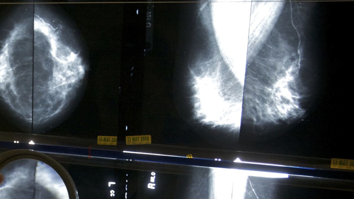 Breast Cancer Screening Guidelines: Navigating Conflicting Advice to Save Lives