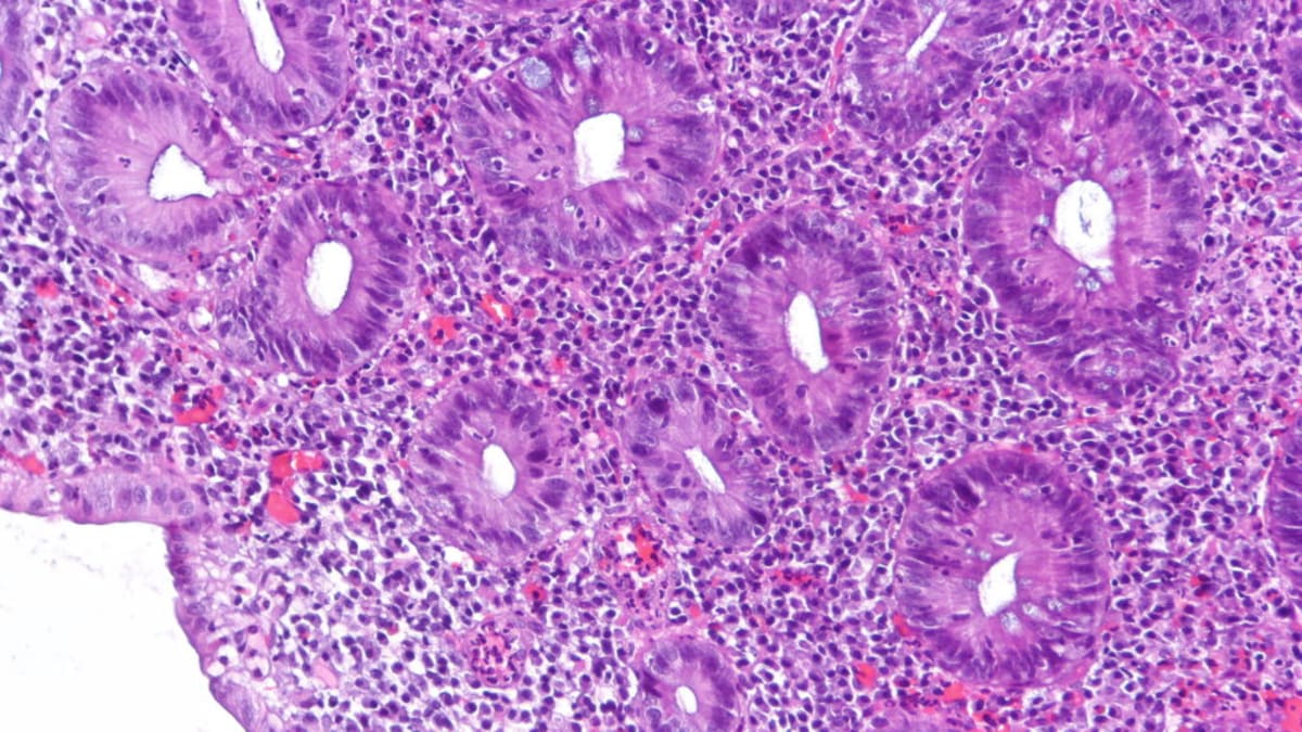 Abivax Ulcerative Colitis Drug Demonstrates Strong Efficacy but Sparks Cancer Safety Concerns