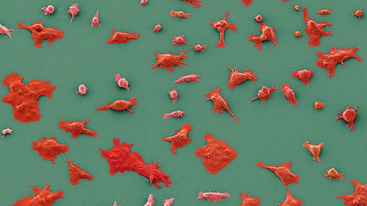 ASCO 2024: Breakthrough Drug Targets Elusive Pancreatic Cancer Protein, Offering New Hope