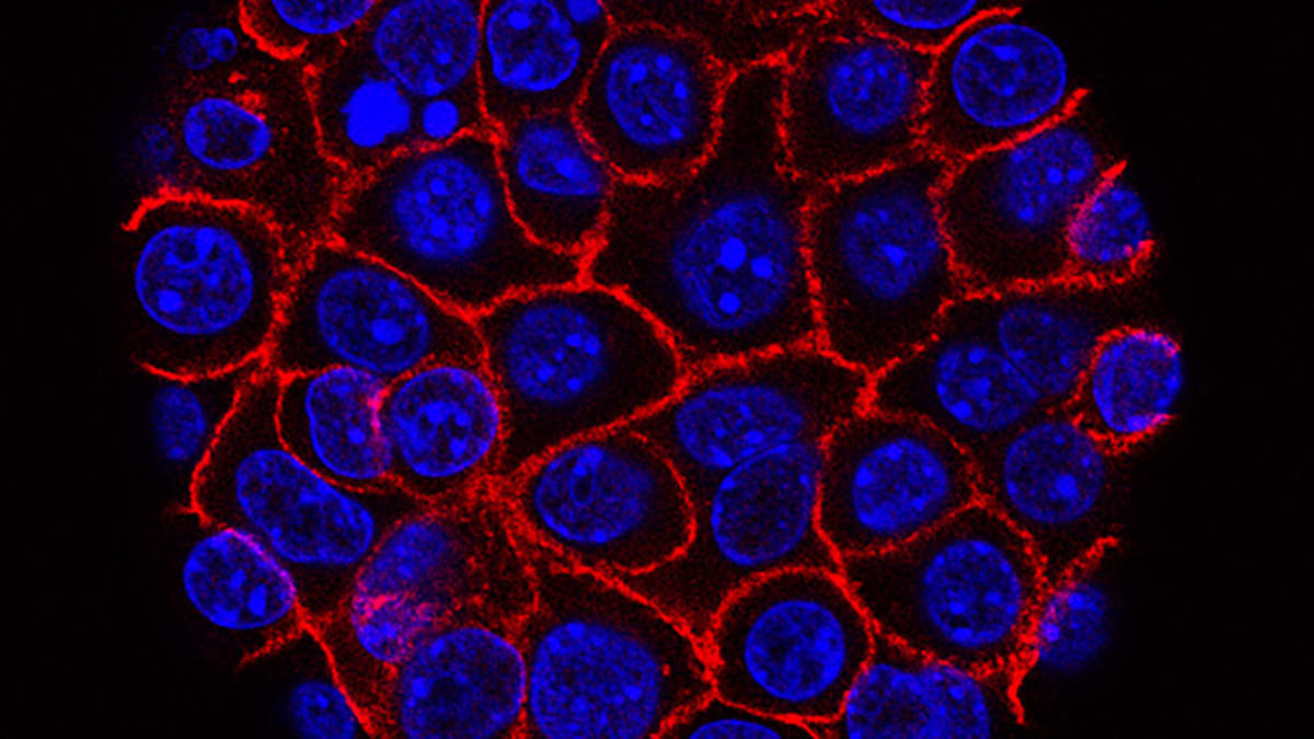 Early Trial Shows Promise: Dual Drug Approach Yields High Response in Pancreatic Cancer Patients