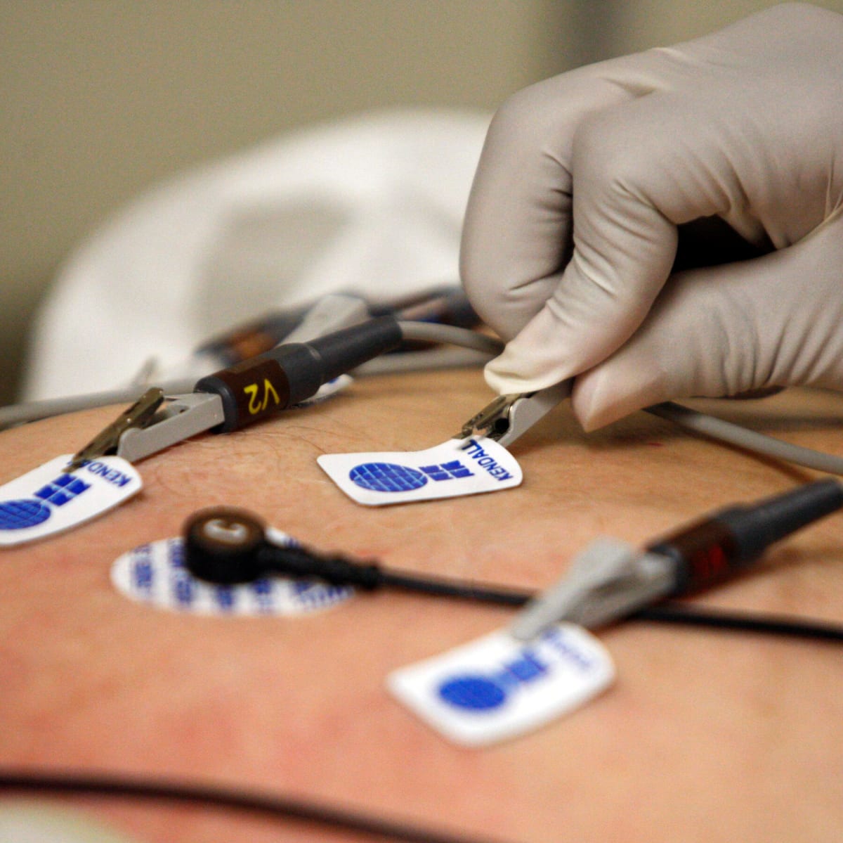 AI Tool Detects Hidden Heart Risks in ECGs Missed by Physicians