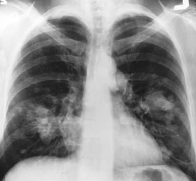 Brain metabolism linked to survival in advanced lung cancer patients