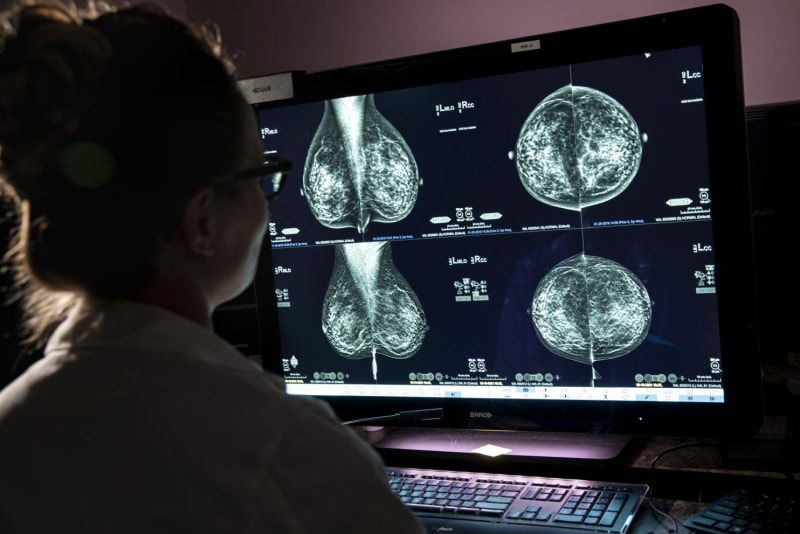 Global Disagreement Over Mammogram Timing Leaves Women Navigating Conflicting Advice