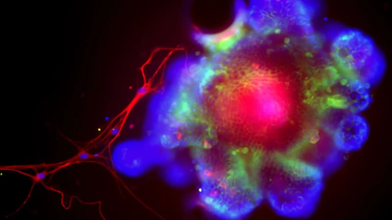 New Protein Pathway Unlocks Predictive Insights for Liver Disease in Alpha-1 Antitrypsin Deficiency