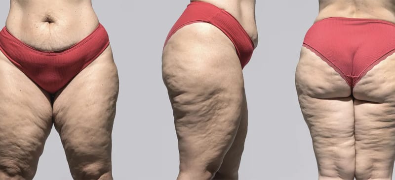 Lipedema: A misunderstood fat disorder that resists diet and exercise, leaving women in chronic pain