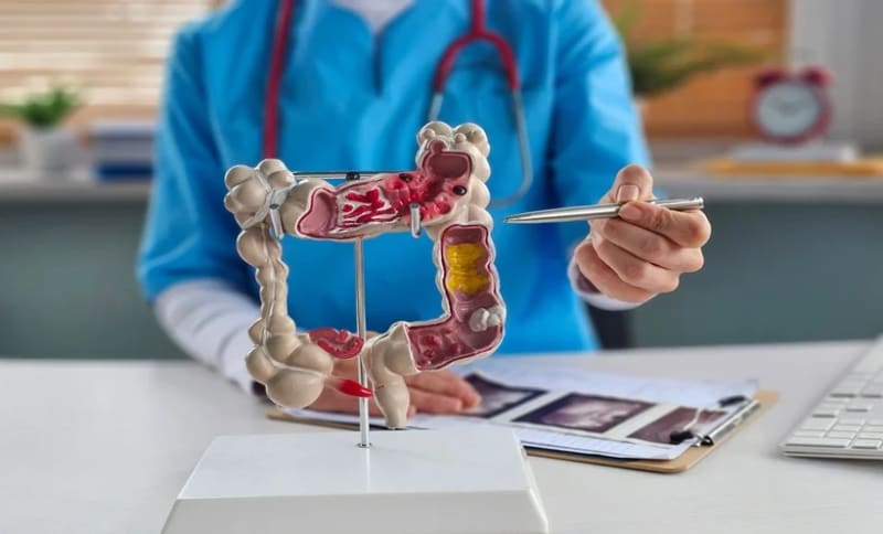 Bowel cancer disparities revealed: people with learning disabilities face systemic care gaps