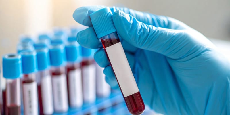 Blood Tests May Soon Predict Alzheimer’s Decades Before Symptoms Appear