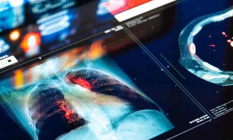 Breakthrough Research: Could an Anti Inflammatory Pill Prevent Lung Cancer?
