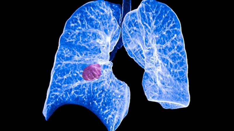 Selpercatinib Cuts Lung Cancer Recurrence Risk by Over 80% in Rare Genetic Subtype, Study Finds