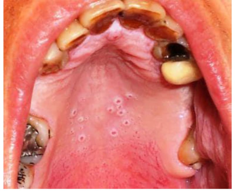 Smoking Alters Palatal Tissue Structure and Blood Flow, New Study Reveals