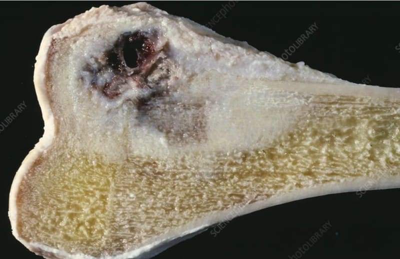 Early Detection Could Transform Bone Cancer Survival Rates, Experts Warn