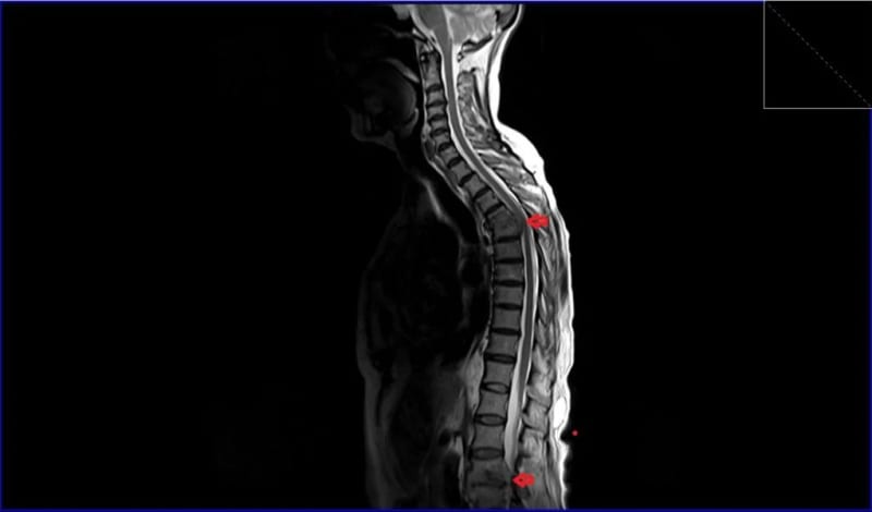 New Cadaver Study Reveals Cervical Spine Extension May Lower Risk of Spinal Canal Injury During Medical Procedures